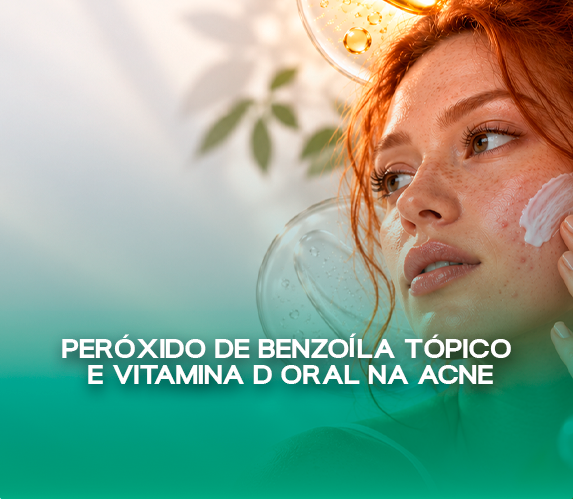 Associação de Peróxido de Benzoíla Tópico e Vitamina D Oral na Acne