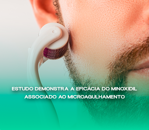 Eficácia do Minoxidil Associado ao Microagulhamento 