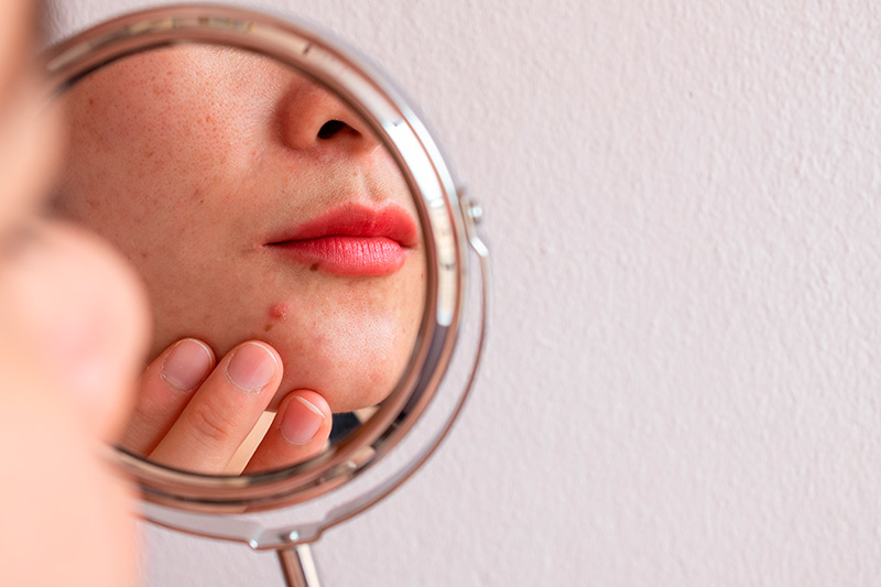 Peróxido de Benzoíla na Acne reduzindo os efeitos adversos