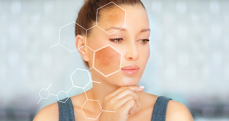 Bilirrubina - Melasma Importância dos Antioxidantes